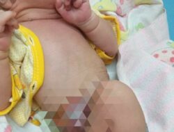 Bayi Usus diluar Tubuh, Butuhkan Uluran tangan dari Semua pihak. 12 Bayi Usus diluar Tubuh, Butuhkan Uluran tangan dari Semua pihak.